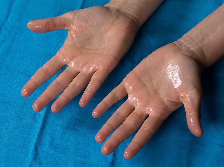 أسباب فرط التعرق وطرق علاجه