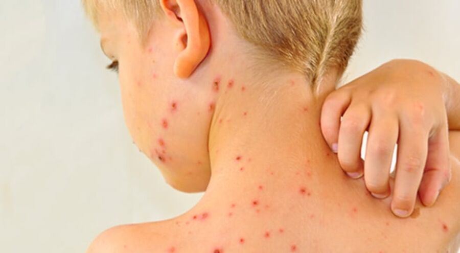 وزارة الصحة: إصابات الحصبة تؤثر على