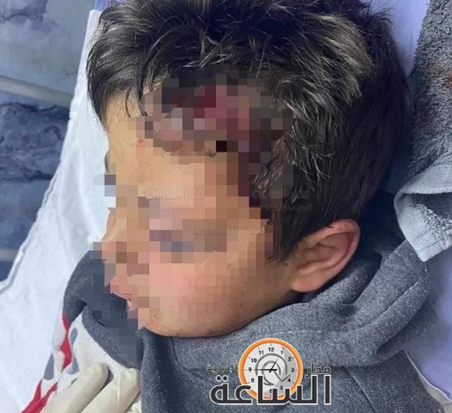 كلب يعقر طفلا في لواء الوسطية..