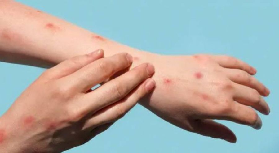 لا حالات في الأردن.. الأوبئة: جدري