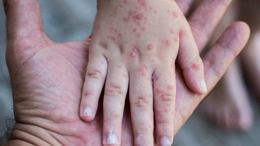 جدري القرود يصل الأردن.. والصحة تكشف