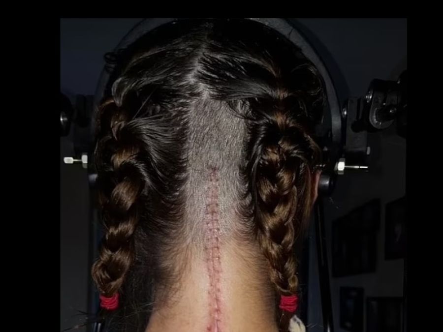 بسبب كرة هوائية.. جراحة نادرة تنقذ