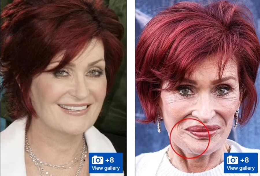 فم أوزمبيك.. تأثير جانبي صادم يحول