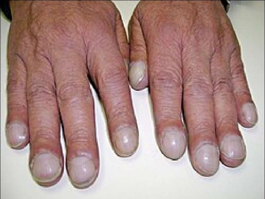 لا تتجاهلها علامة خفية في أطراف