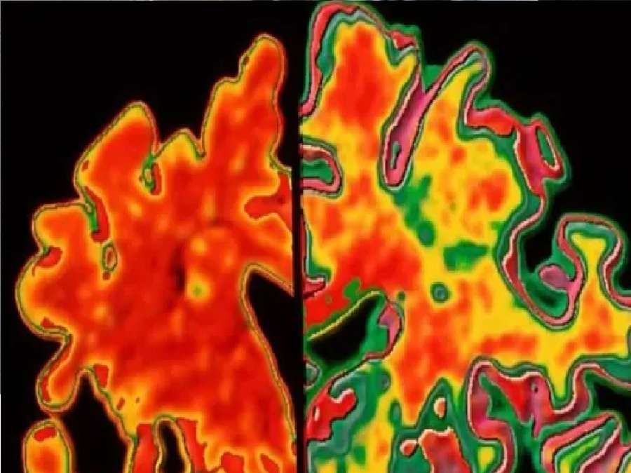 ركوب الدراجة يحمي الدماغ من الخرف