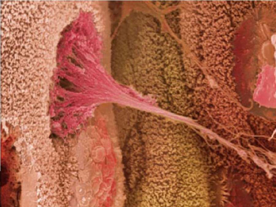 بسبب نوبة سعال.. تمزق قولون امرأة