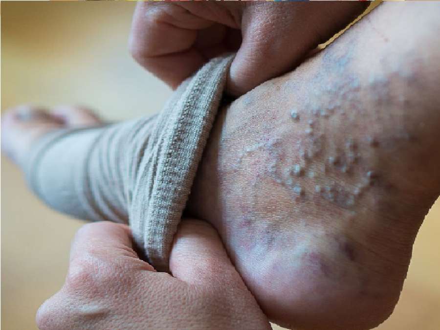 برودة الأطراف مؤشر مبكر يسبق دوالي