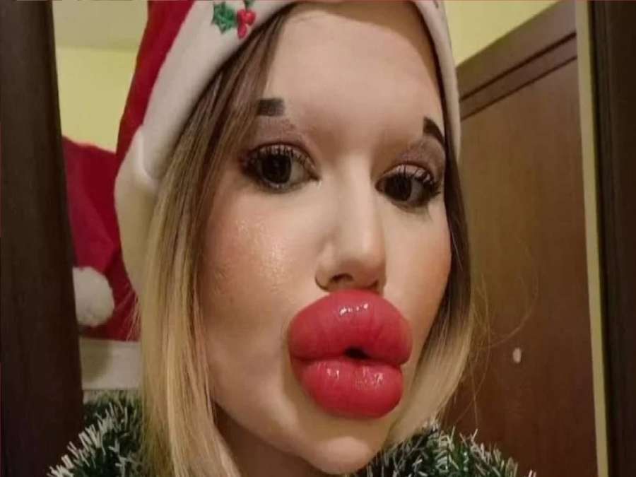 بسبب مظهرها.. صاحبة أكبر شفاه في