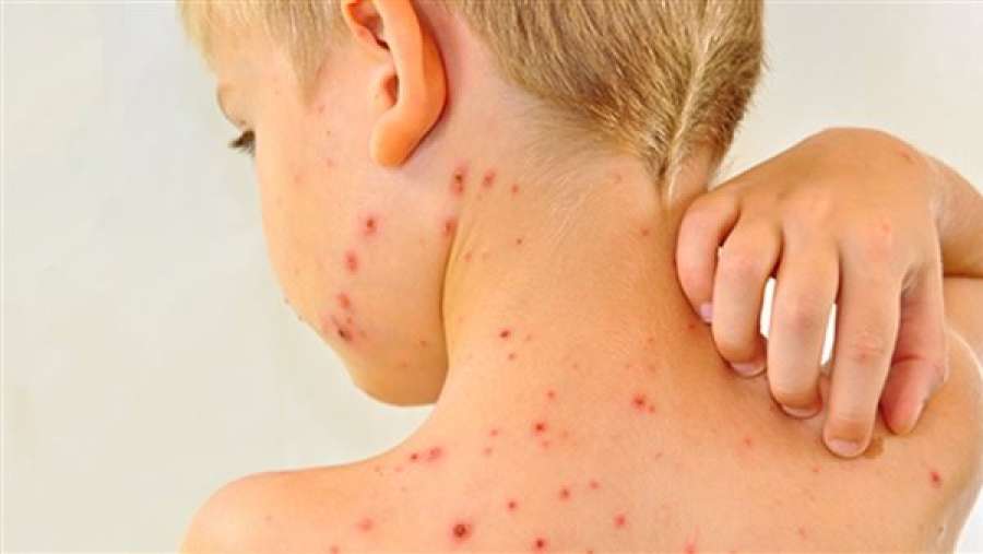 ضحايا نظرية المؤامرة.. تفشي الحصبة في