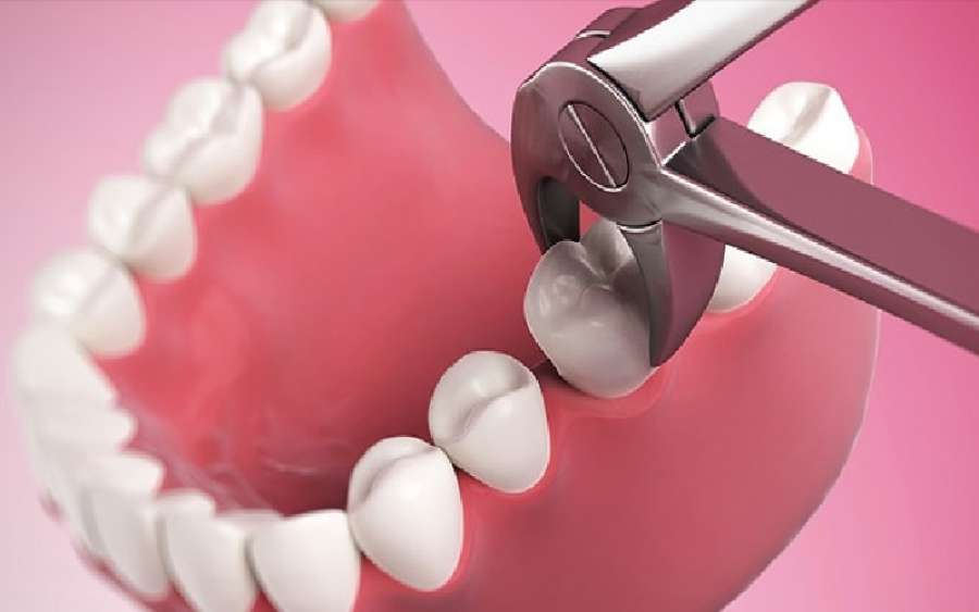 هل للسن اذا قلع بالخطأ دية؟