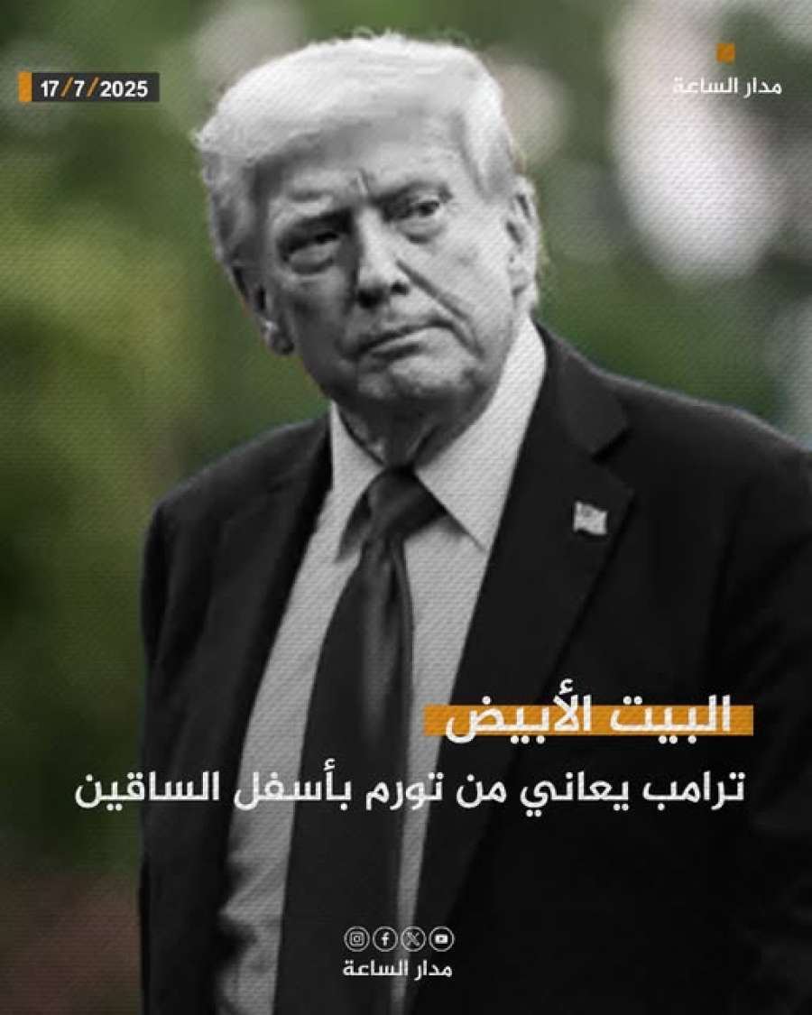 ترامب مصاب بتورم في ساقيه.. ما