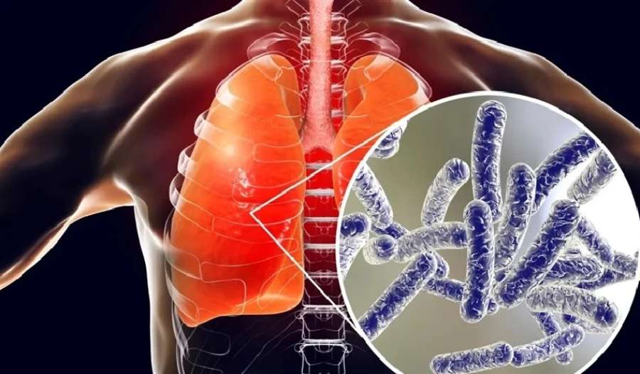 داء الفيالقة.. مرض رئوي قاتل ينتشر
