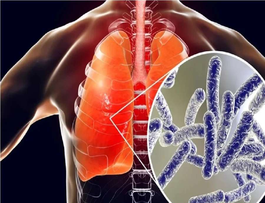 داء الفيالقة.. مرض رئوي قاتل ينتشر