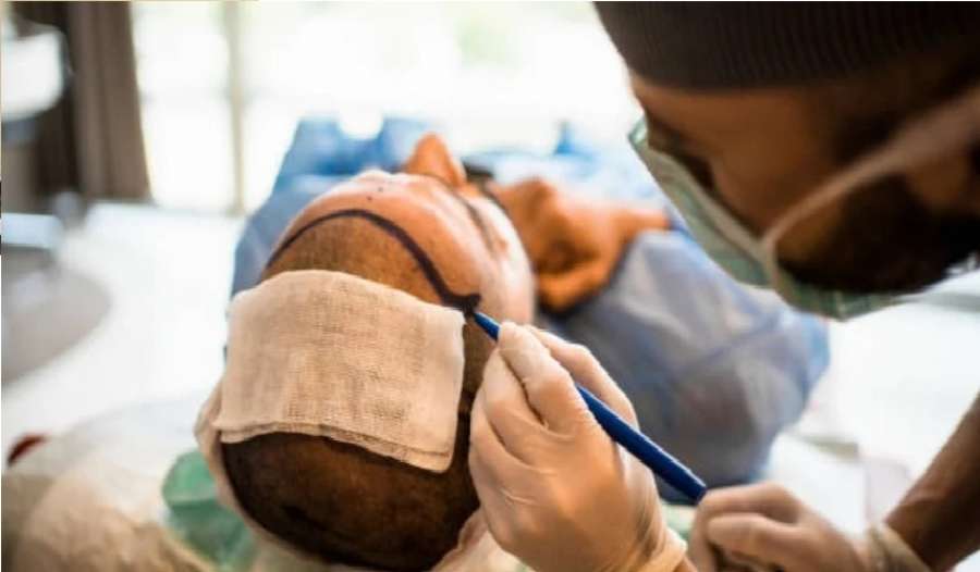 قبل عملية زراعة الشعر.. وفاة غامضة