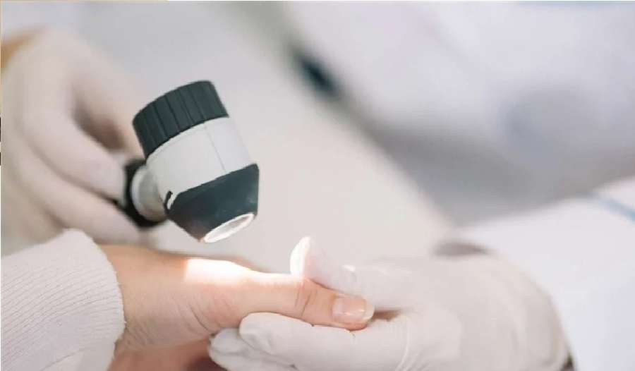 قريبا.. اختبار منزلي بسيط لسرطان الجلد