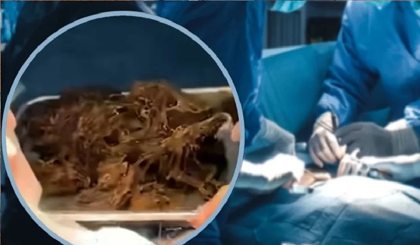 أطباء يستخرجون 2 كيلوغرام شعر من