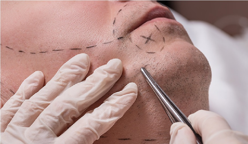 حكم استخدام مواد لاستنبات اللحية، وهل