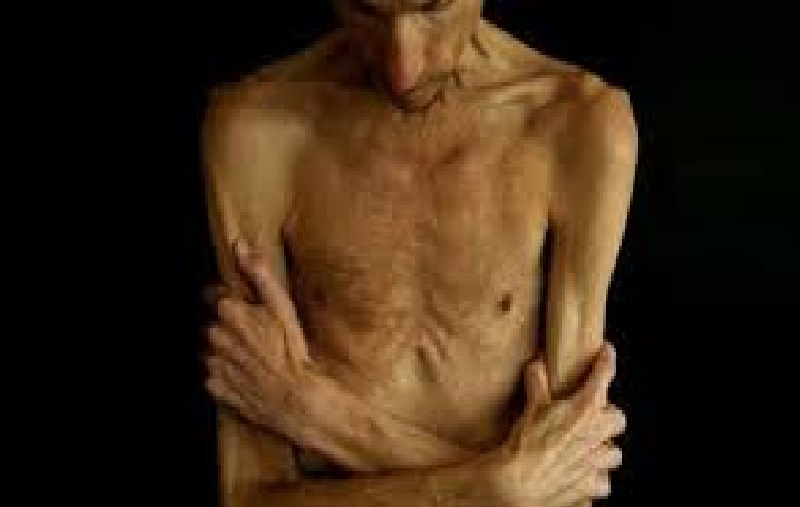 دراسة: النحافة المفرطة أخطر على الصحة