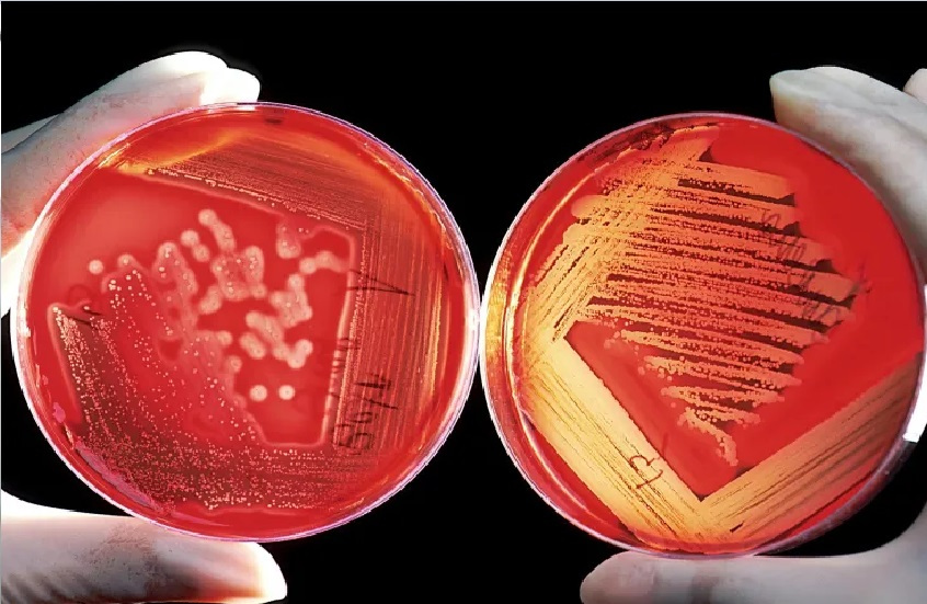 ميكروبات الفم قد تساهم في سرطان