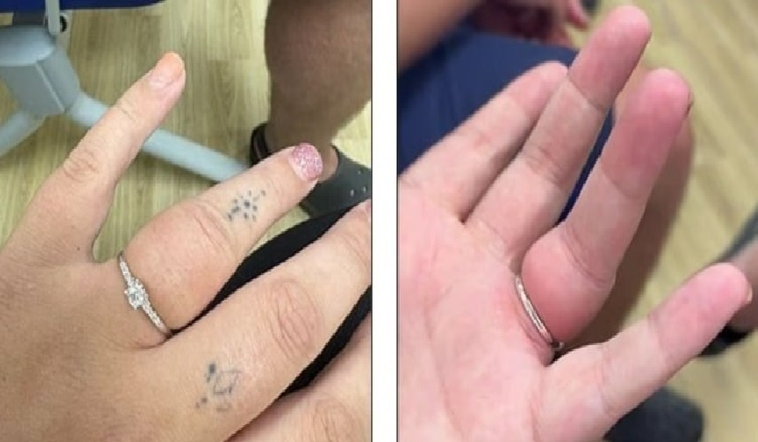 خاتم خطوبة يهدد إصبع شابة بـالبتر