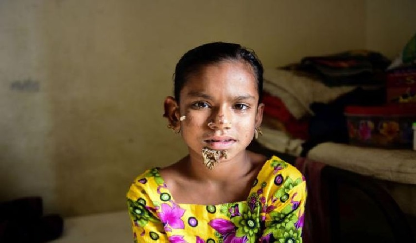 متلازمة الرجل الشجرة.. التفاصيل الكاملة عن