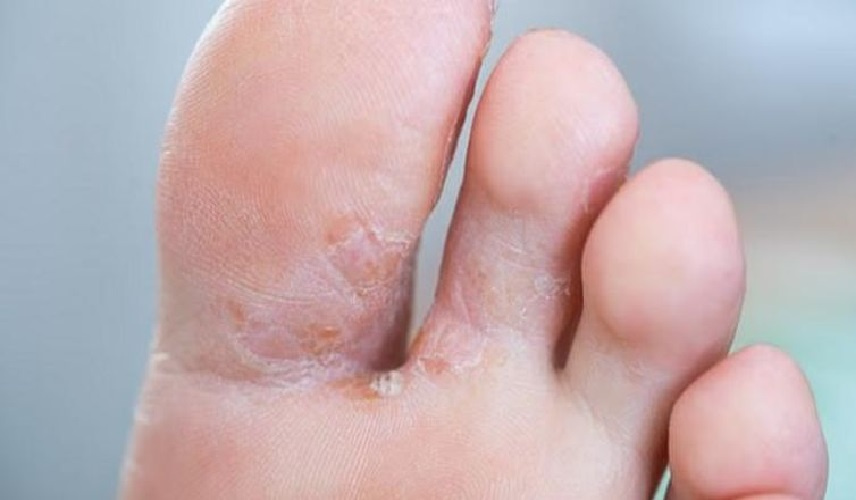 إهمال تجفيف القدمين كاد يودي بحياة