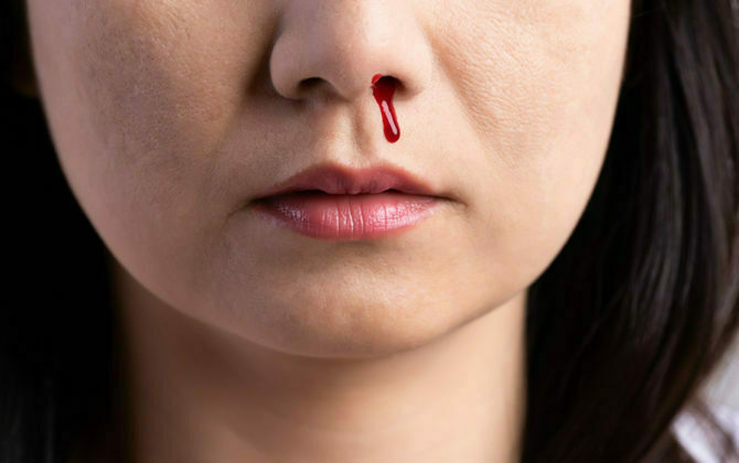 الرعاف.. أسبابه وطرق تشخيصه وعلاجه