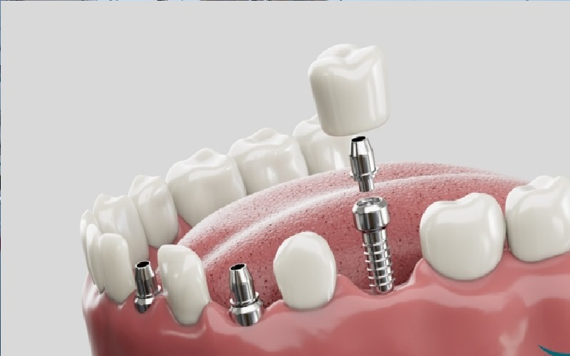 وداعا لزراعة الأسنان.. عقار جديد يحفز
