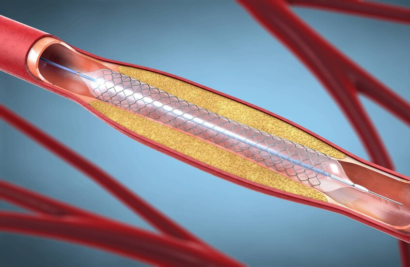 باحثون روس يطورون دعامة وعائية حيوية