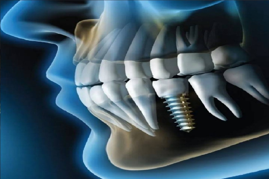 تيجان الأسنان ثلاثية الأبعاد تطبع بـ