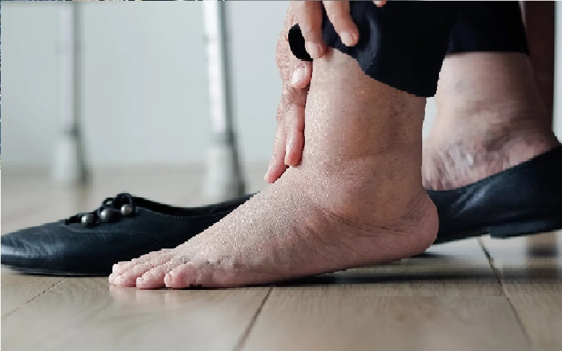 تورّم الساقين الدائم.. ماذا يعني؟