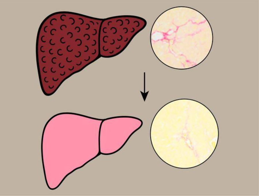 نبات الحناء يعالج الكبد