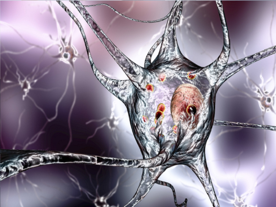 تململ الساقين.. نذير باركنسون؟ دراسة كورية