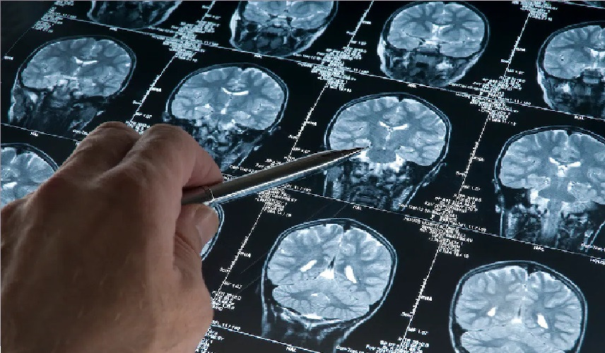 وقاية من الزهايمر: 5 آلاف خطوة