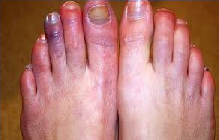 برودة اليدين والقدمين: متى يجب استشارة