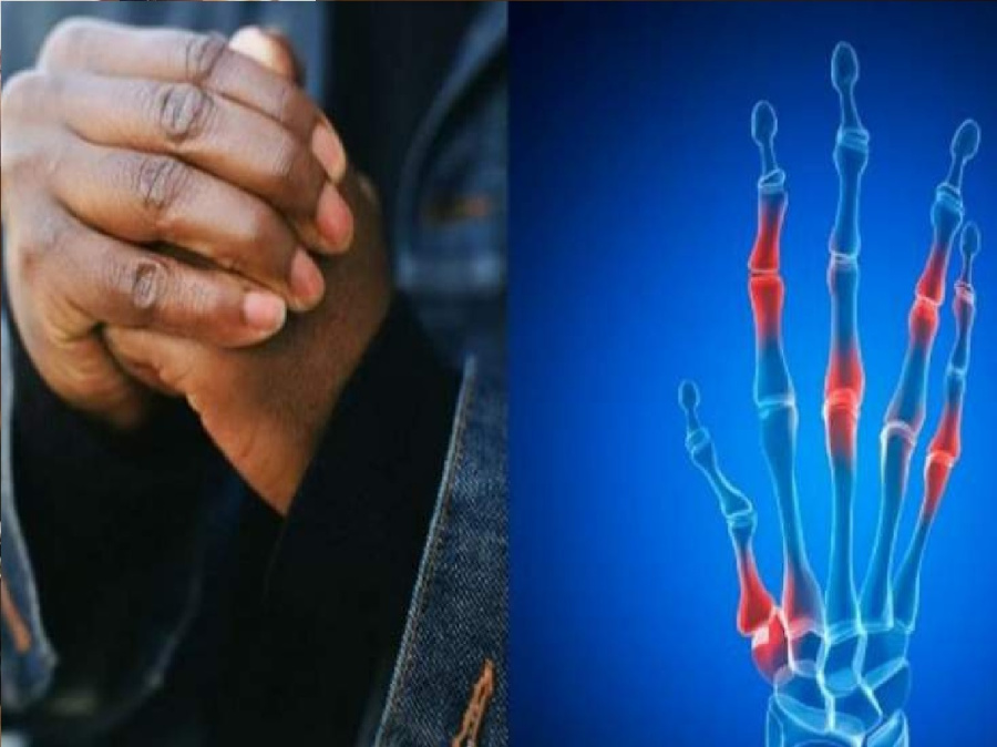 طقطقة الأصابع تسبب التهاب المفاصل؟: الحقيقة