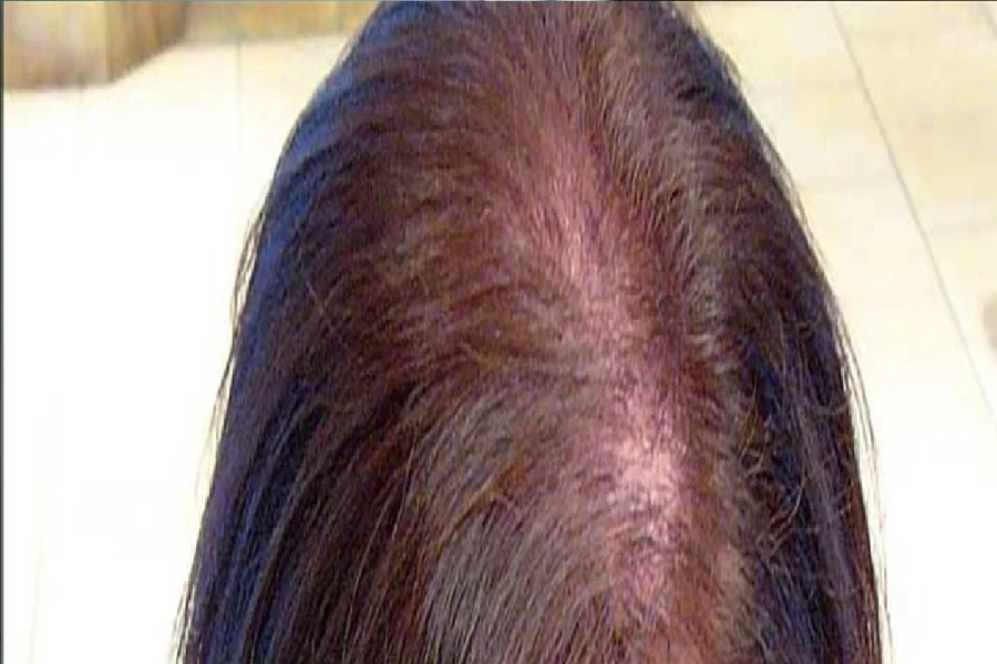 لتجنب ترقق الشعر: لماذا يحذّر الخبراء