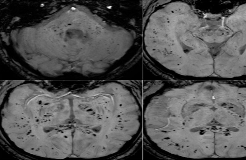 تحليل بالرنين المغناطيسي يكشف تأثير كوفيد-19