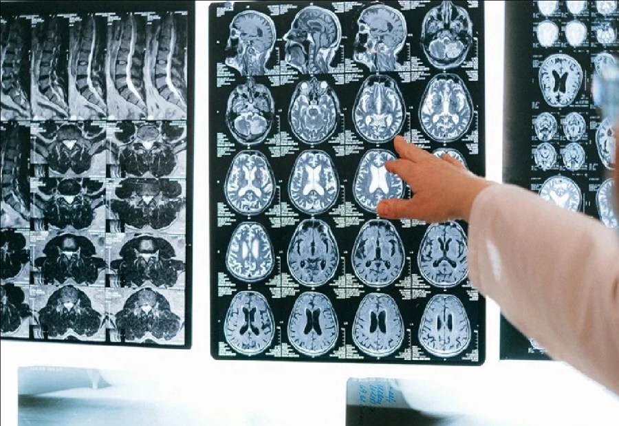 ثورة في علاج الأرومة الدبقية: مكملات