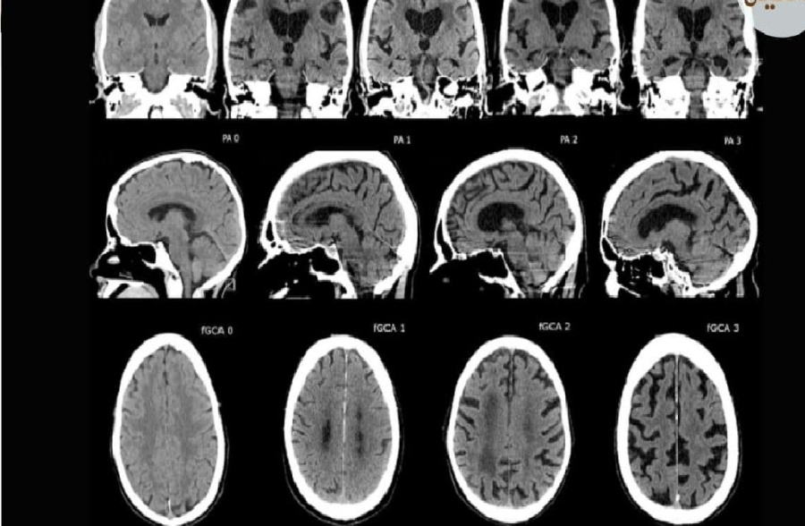 خطر الضمور المعرفي: كيف يؤدي الاعتماد