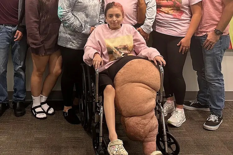 ورم نادر بوزن 80 كيلوغراما يتسبب