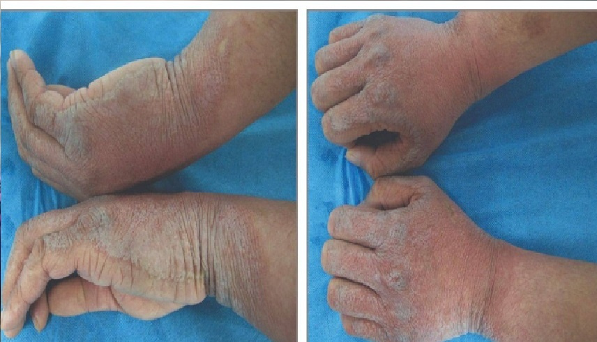 علامة اليد في الدلو.. حالة طبية