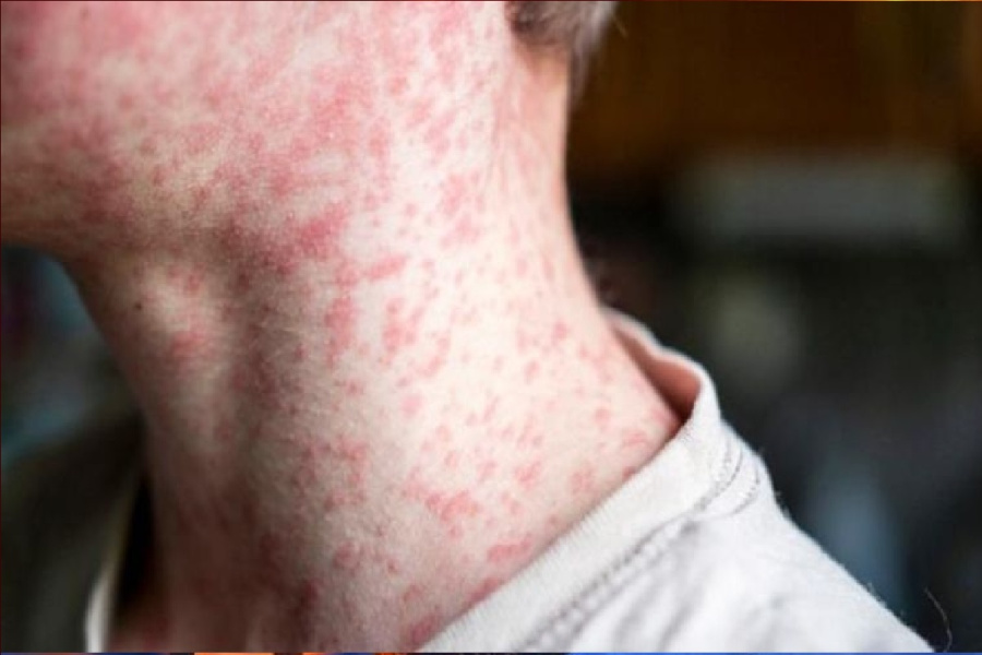 أستراليا تعلن حالة التأهب: إصابات الحصبة