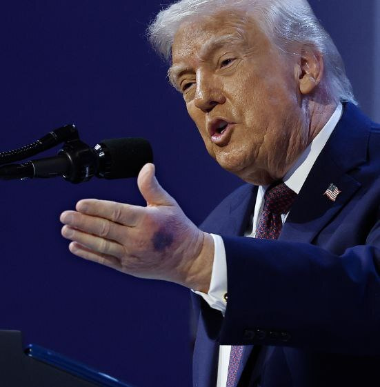 ما طبيعة الأصابة التي تعرض لها