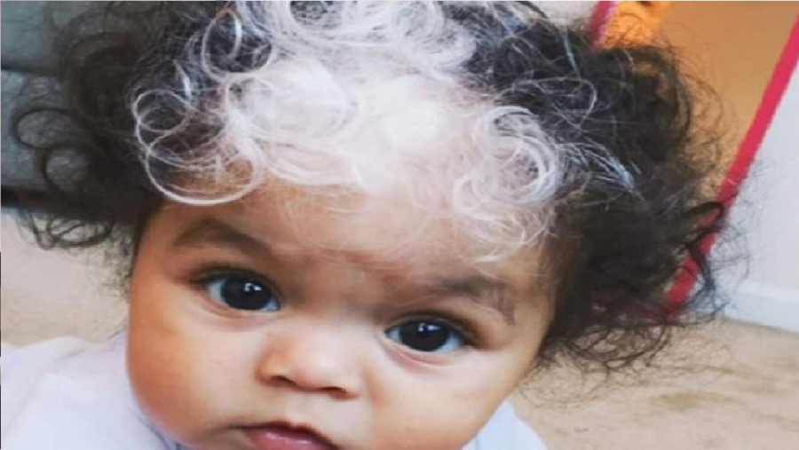 لغز الخصلة البيضاء.. ما هي ظاهرة