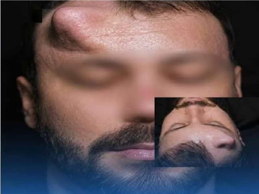 جراحة ترميمية معقدة.. زراعة أنف مؤقتة