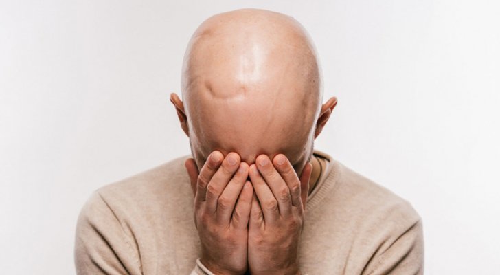 دراسة غير سارة للصلع