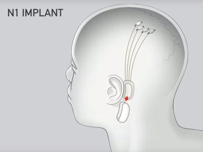 شريحة ذكية تعالج الأمراض العصبية