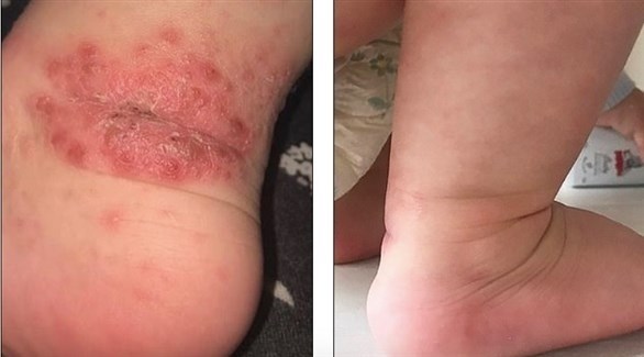 كريم رخيص يشفي طفلا من أكزيما