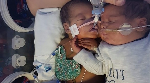 مولود ينقذ حياة شقيقه التوأم عبر